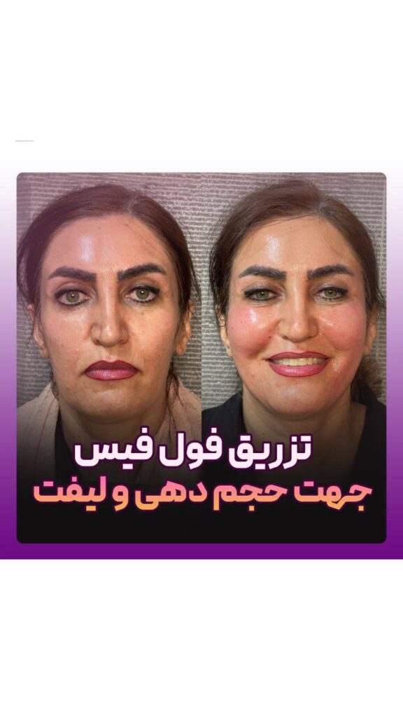 تزریق فول فیس