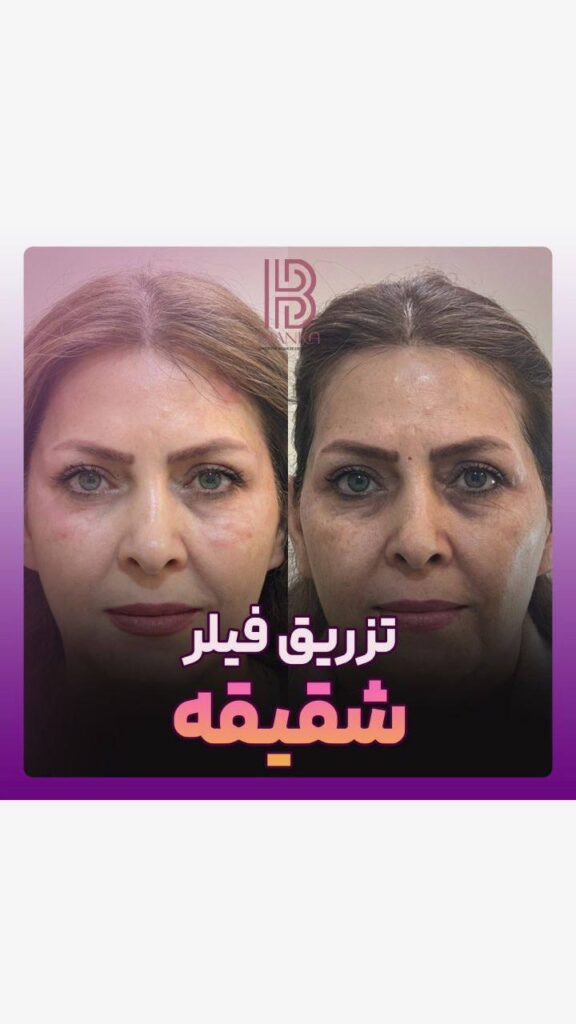 کلینیک زیبایی بیانکا تزریق فیلر شقیقه