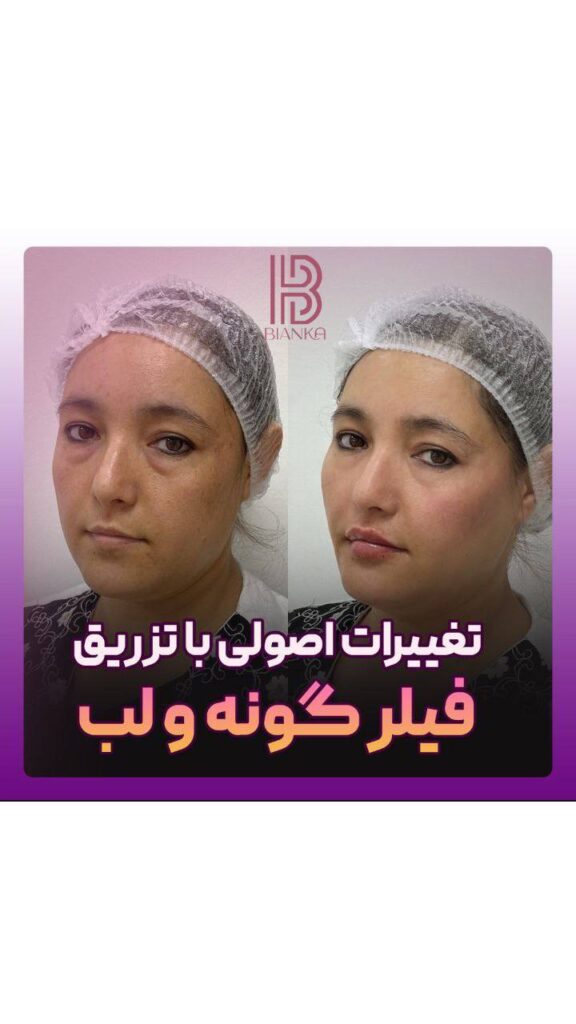 کلینیک زیبایی بیانکا فیلر گونه