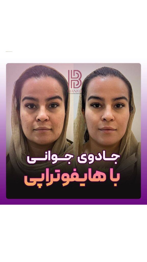کلینیک زیبایی بیانکا هایفوتراپی